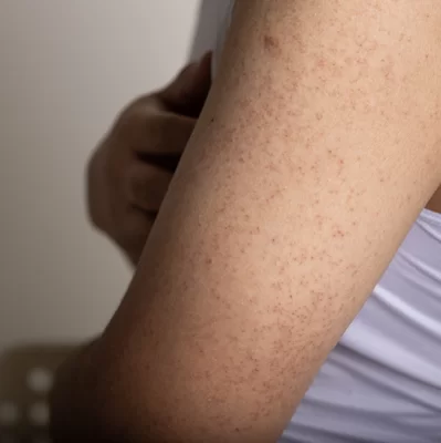 Rogowacenie mieszkowe