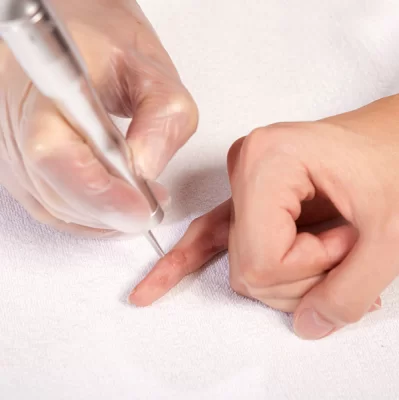 Jak pozbyć się kurzajek?