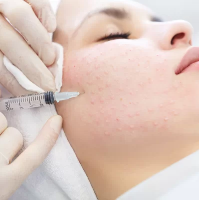 Mezoterapia igłowa: co to?