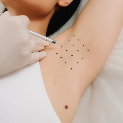 Skuteczne leczenie nadpotliwości