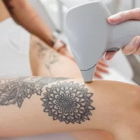 Depilacja laserowa a tatuaż