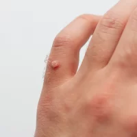 Jak pozbyć się kurzajek?