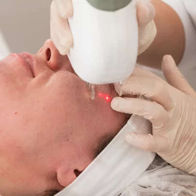Jak przyspieszyć gojenie po laserze frakcyjnym?