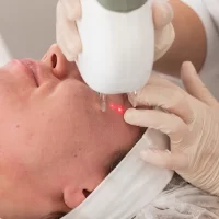 Jak przyspieszyć gojenie po laserze frakcyjnym?