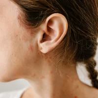 Łuszczyca na twarzy