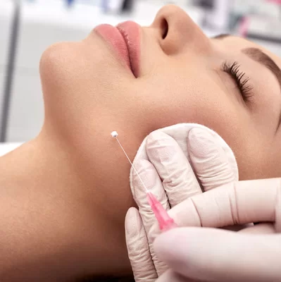 Jak działają nici liftingujące Aptos na podbródek?