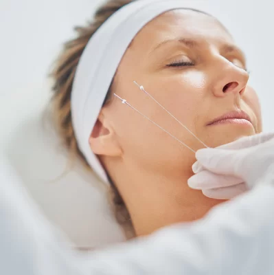 Czym są nici PDO i jak działają na podbródek?