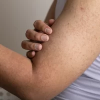 Rogowacenie mieszkowe