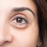 Worki pod oczami - przyczyna