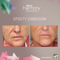 Laserowy resurfacing skóry - laser frakcyjny ablacyjny -20%