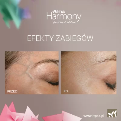 Laserowe usuwanie rumienia i naczynek na twarzy -20%
