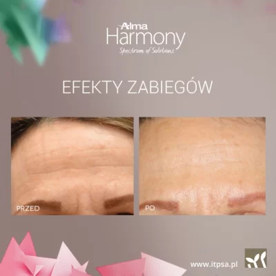 Lifting laserowy - Laser frakcyjny nieablacyjny -20%