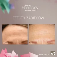 Lifting laserowy - Laser frakcyjny nieablacyjny -20%