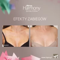 Usuwanie przebarwień laserem -20%