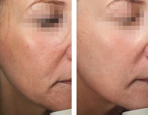 Lifting hybrydowy Alma Hybrid + laser CO₂ na powieki w prezencie