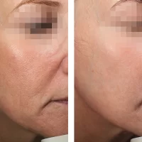 Lifting hybrydowy Alma Hybrid + laser CO₂ na powieki w prezencie