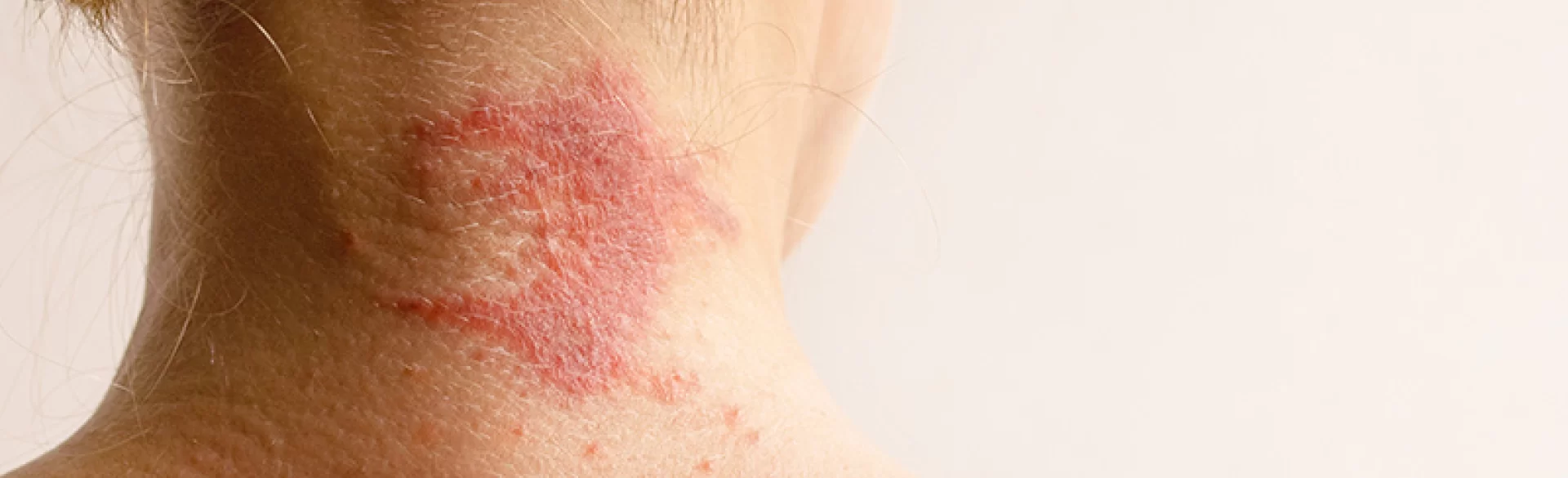 Atopowe zapalenie skóry głowy