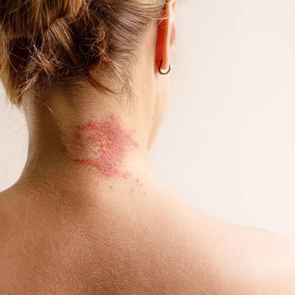 Atopowe zapalenie skóry głowy