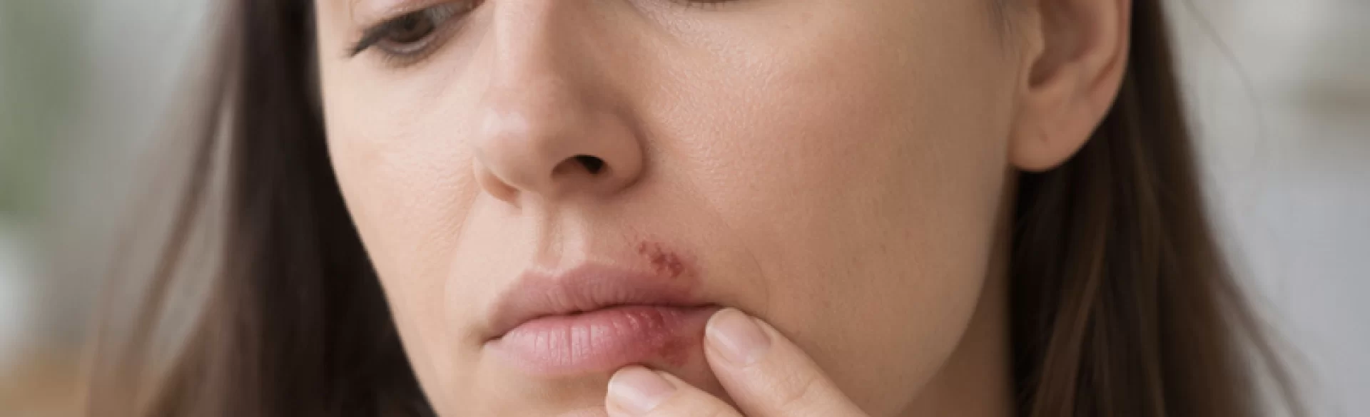 Blizny po opryszczce