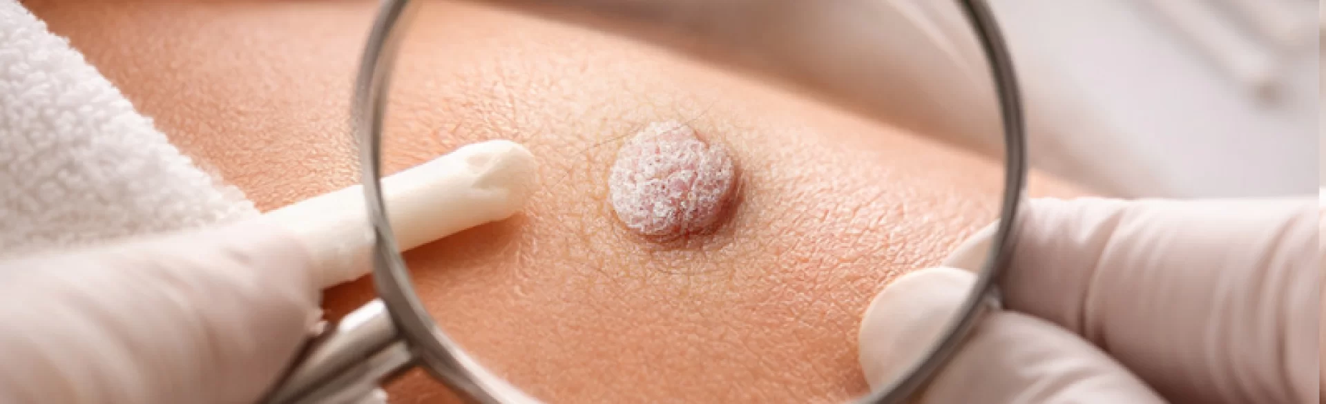 Brodawki narządów płciowych