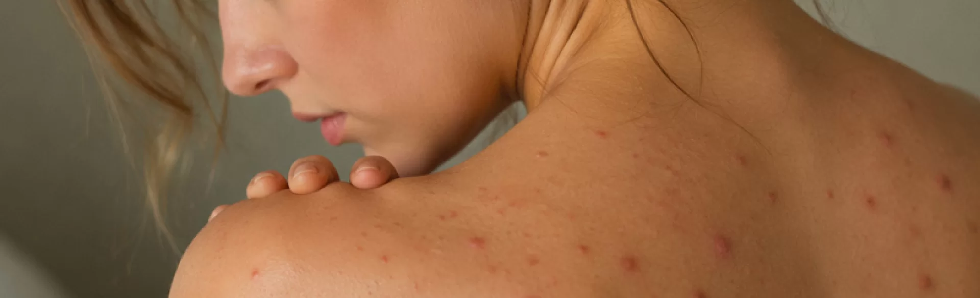 Czerwone krosty na plecach