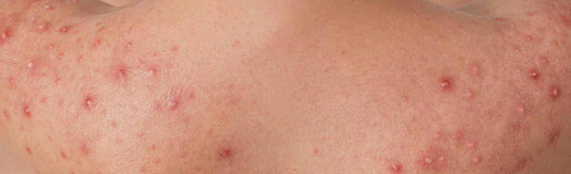 Pryszcze na ramionach