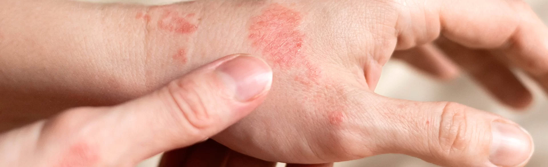 Egzema na dłoniach