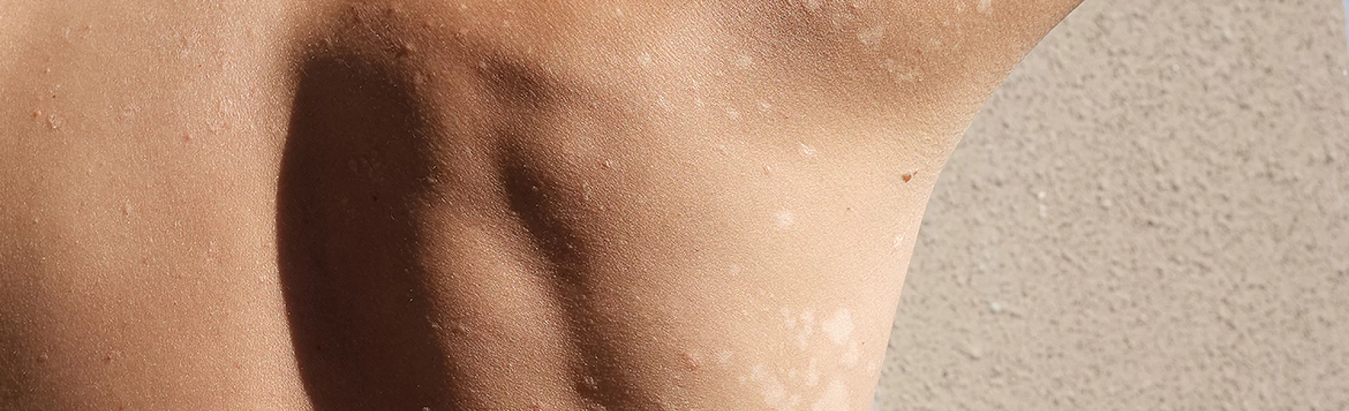 Erytrodermia łuszczycowa