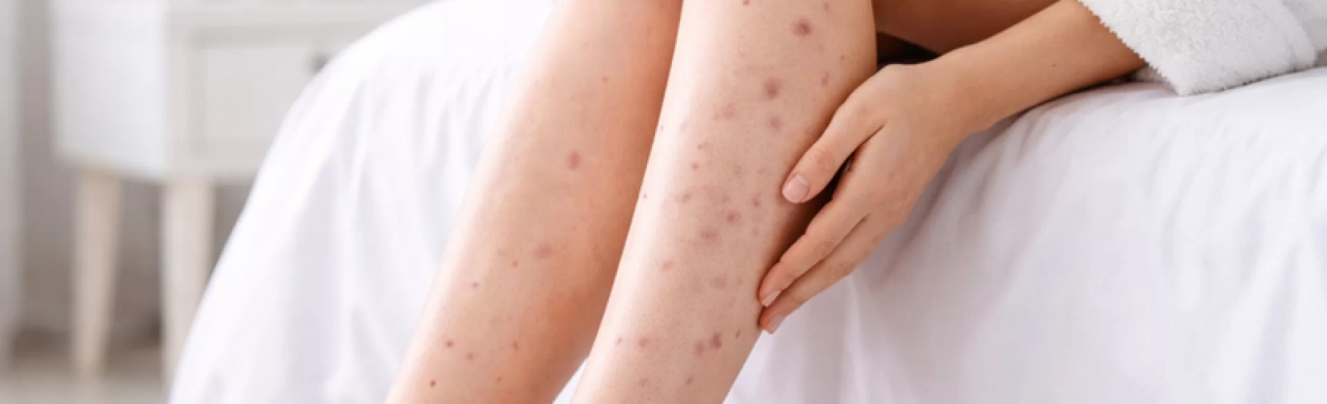 Fioletowe krosty na nogach