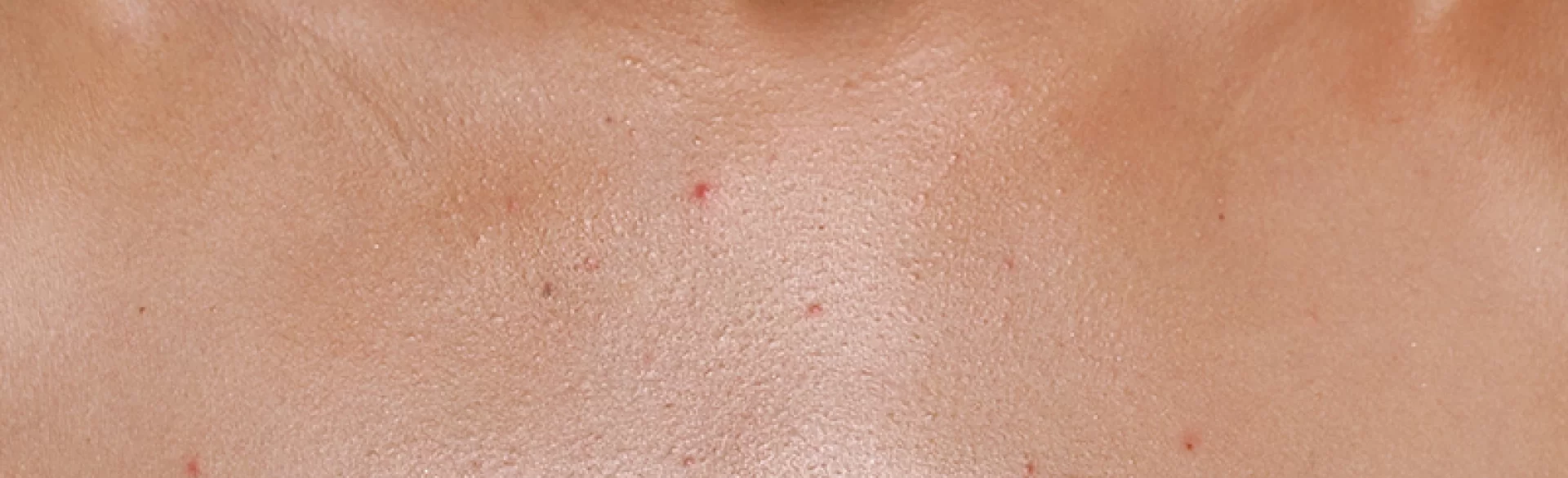 Krosty między piersiami