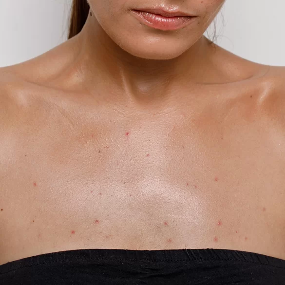 Krosty między piersiami