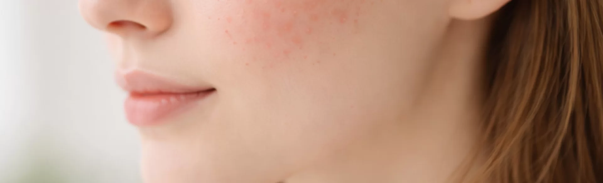 Krosty na policzkach