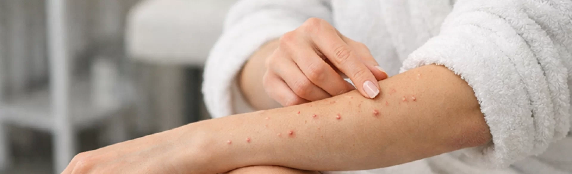 Krosty ropne na rękach