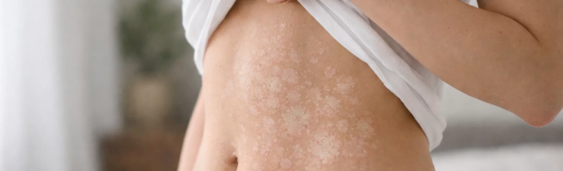 Łupież pstry na brzuchu