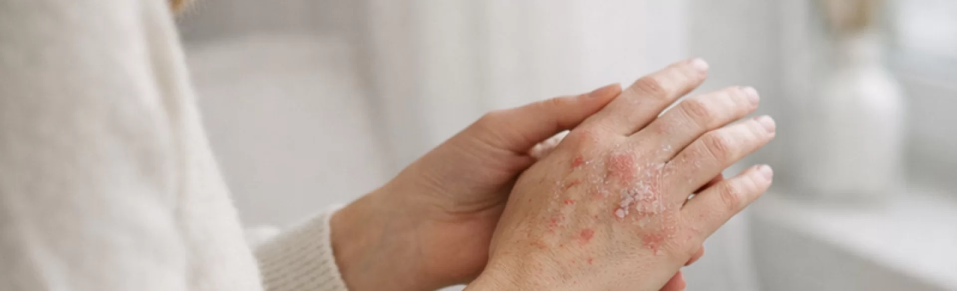 Łuszczyca dłoni