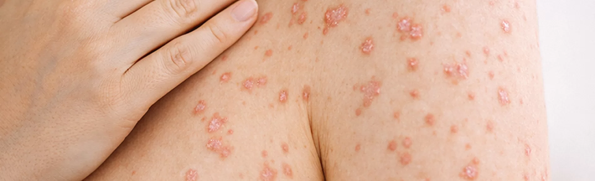 Łuszczyca kropelkowa