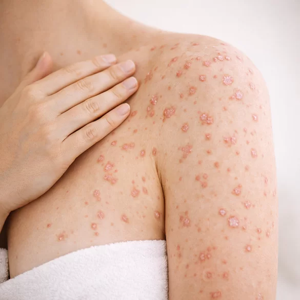 Łuszczyca kropelkowa