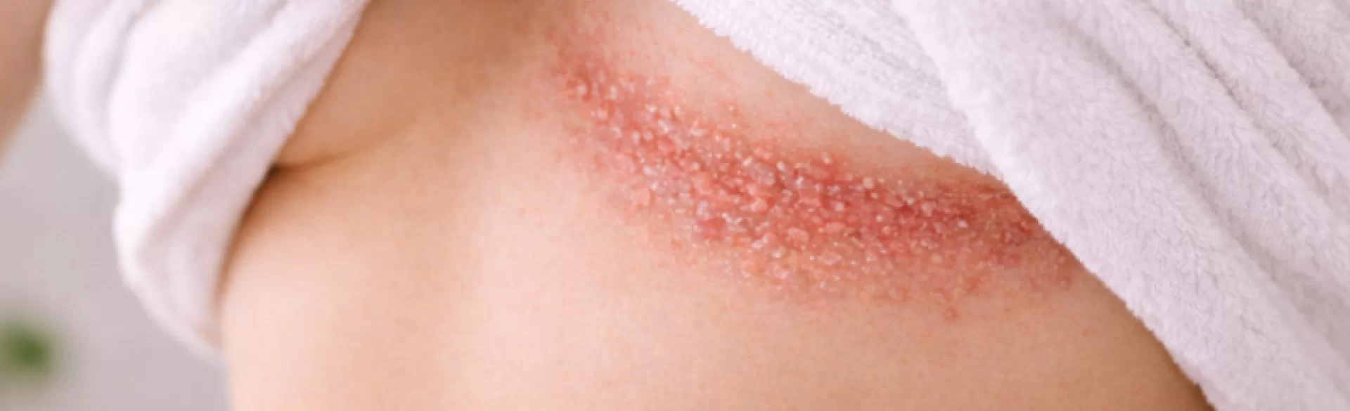 Łuszczyca odwrócona