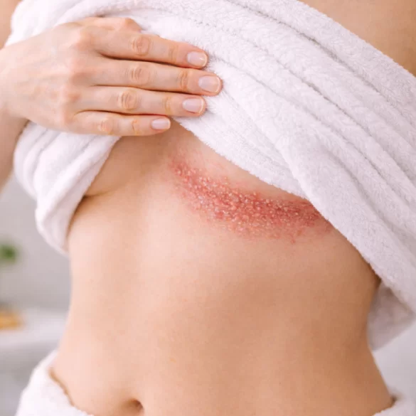 Łuszczyca odwrócona