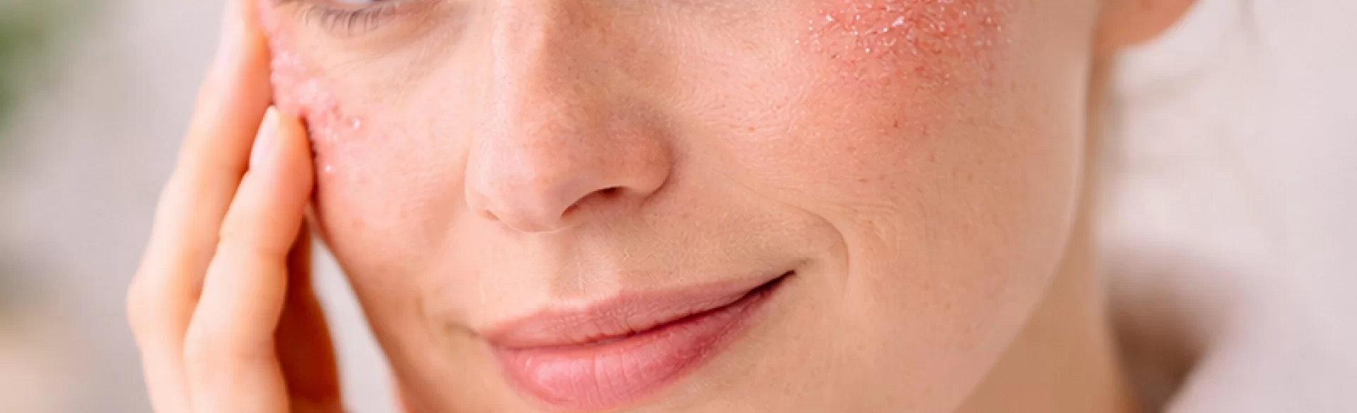 Łuszczyca twarzy