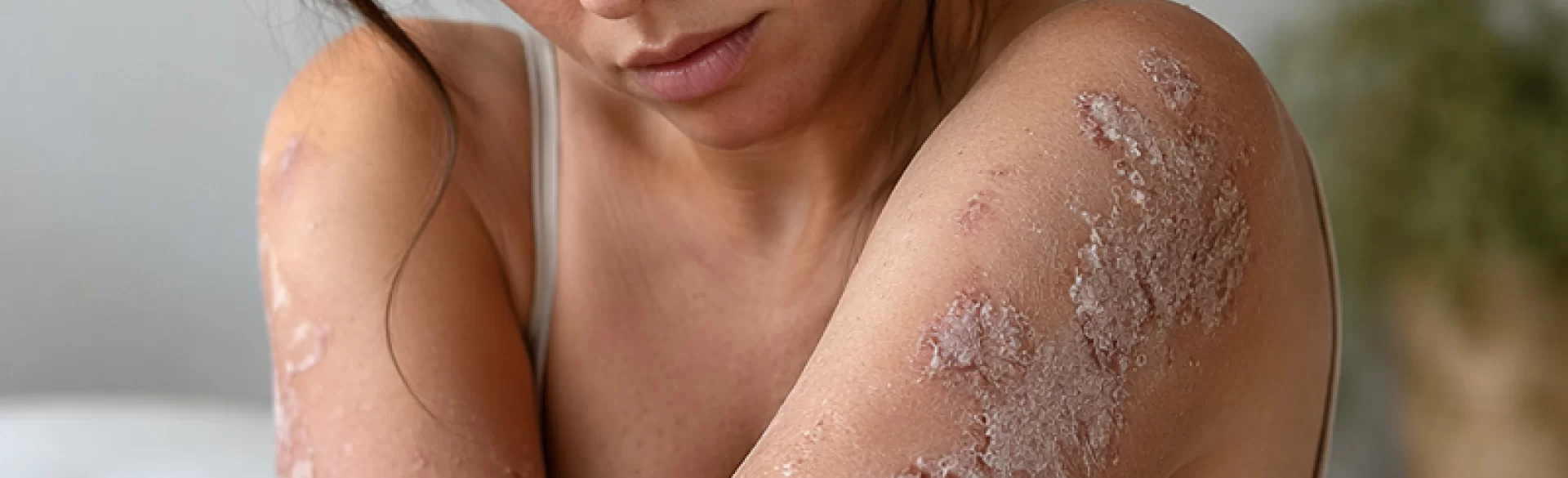 Łuszczyca zadawniona