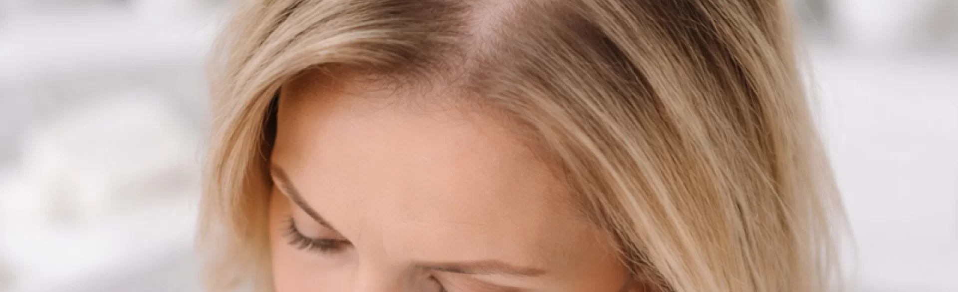 Łysienie na czubku głowy