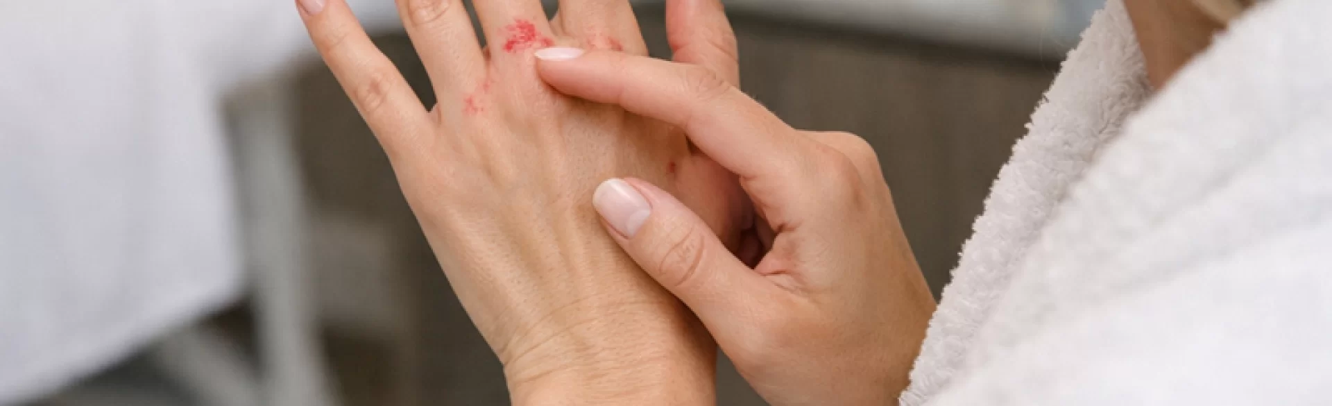 Krosty między palcami u rąk