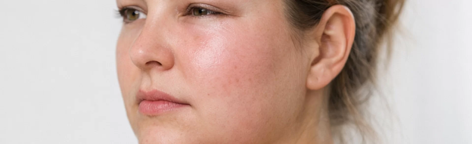 Nagły obrzęk twarzy