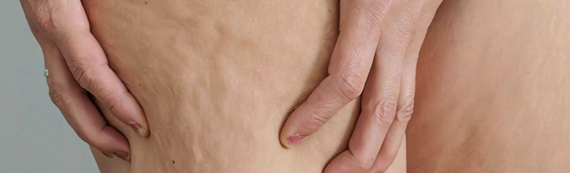 Obrzęki tłuszczowe