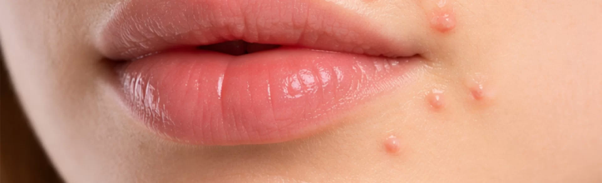 Pryszcze koło ust
