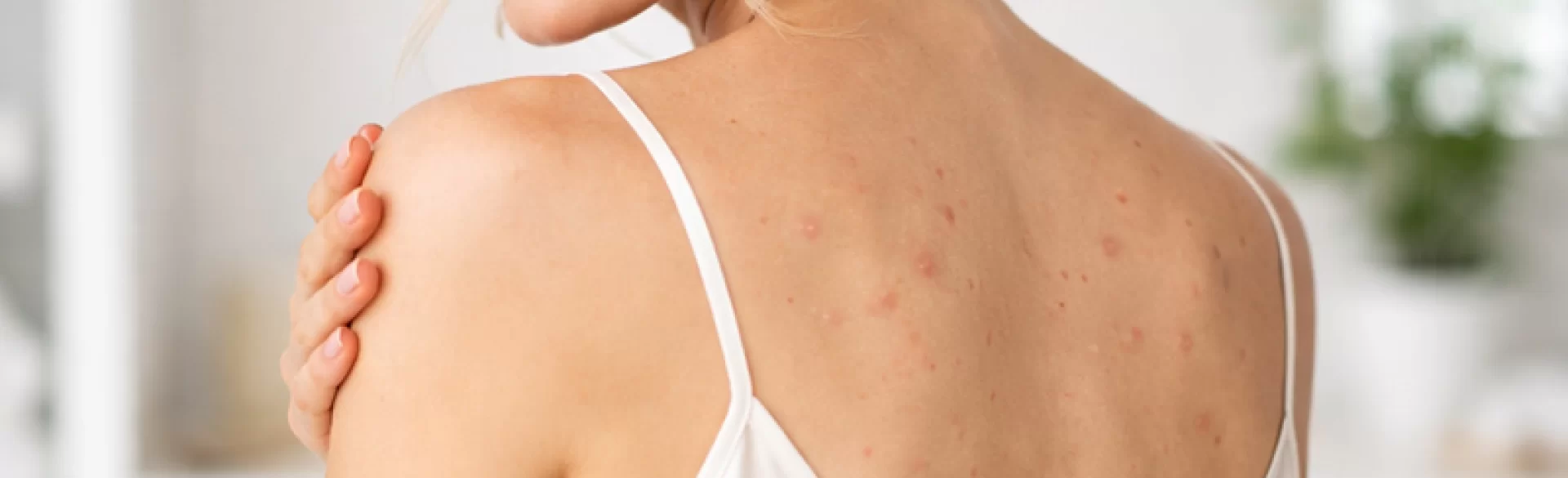 Pryszcze ropne na plecach