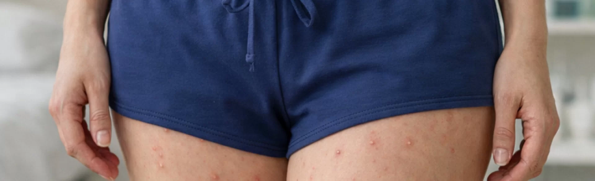 Pryszcze ropne na udach