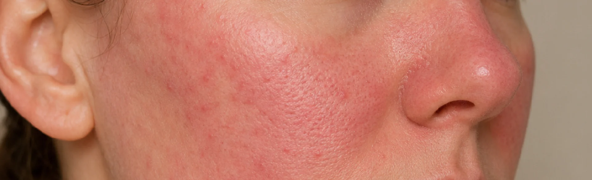 Trądzik różowaty (rosacea)