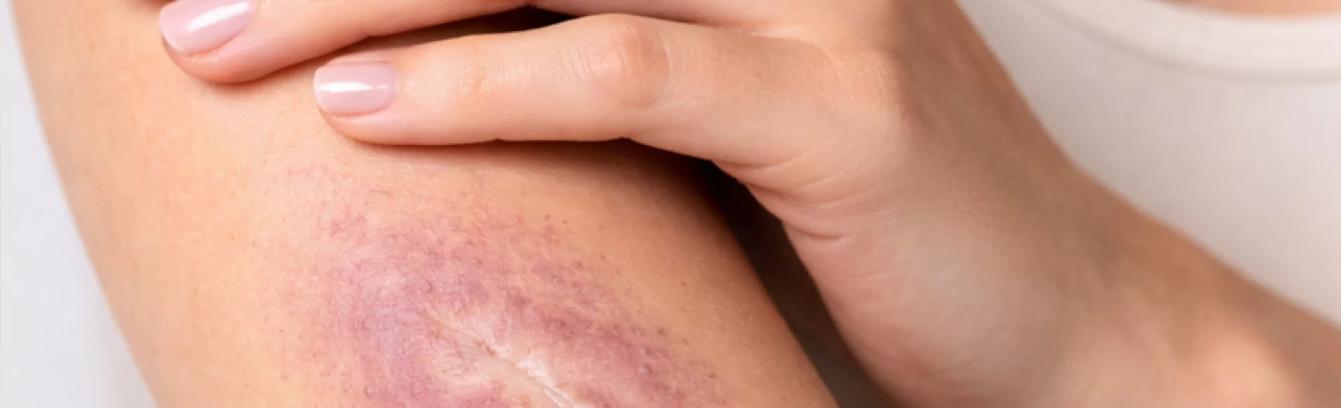 Twardzina ograniczona